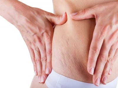 Stretch Marks And Scarring Ftt Skin Clinics Glasgow Hamilton Inverness