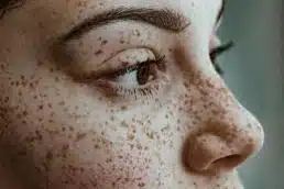 freckles