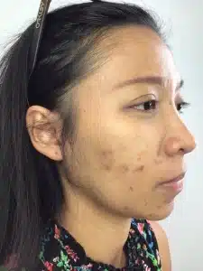 Acne Skin Concern