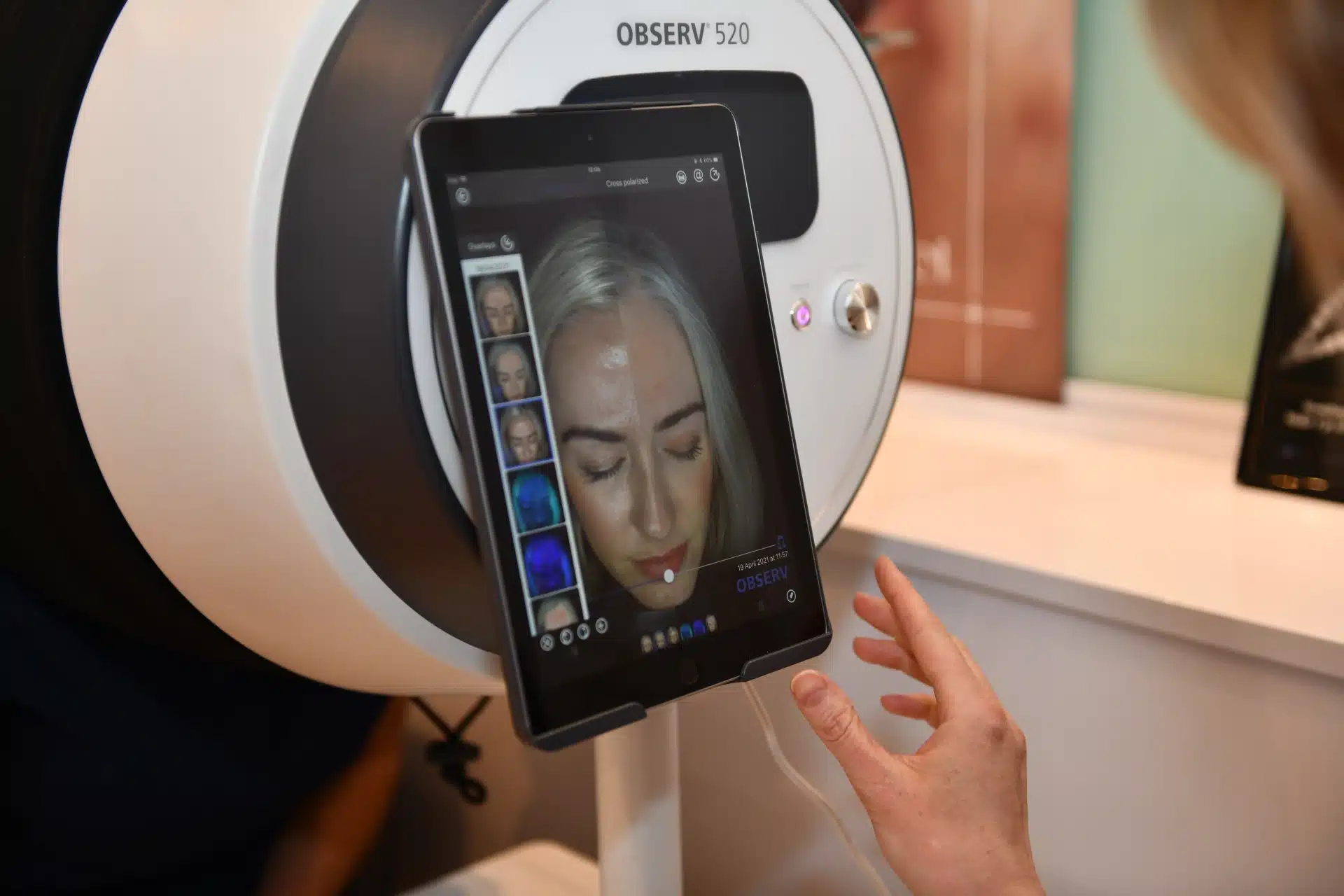 Skin Analysis for Acne