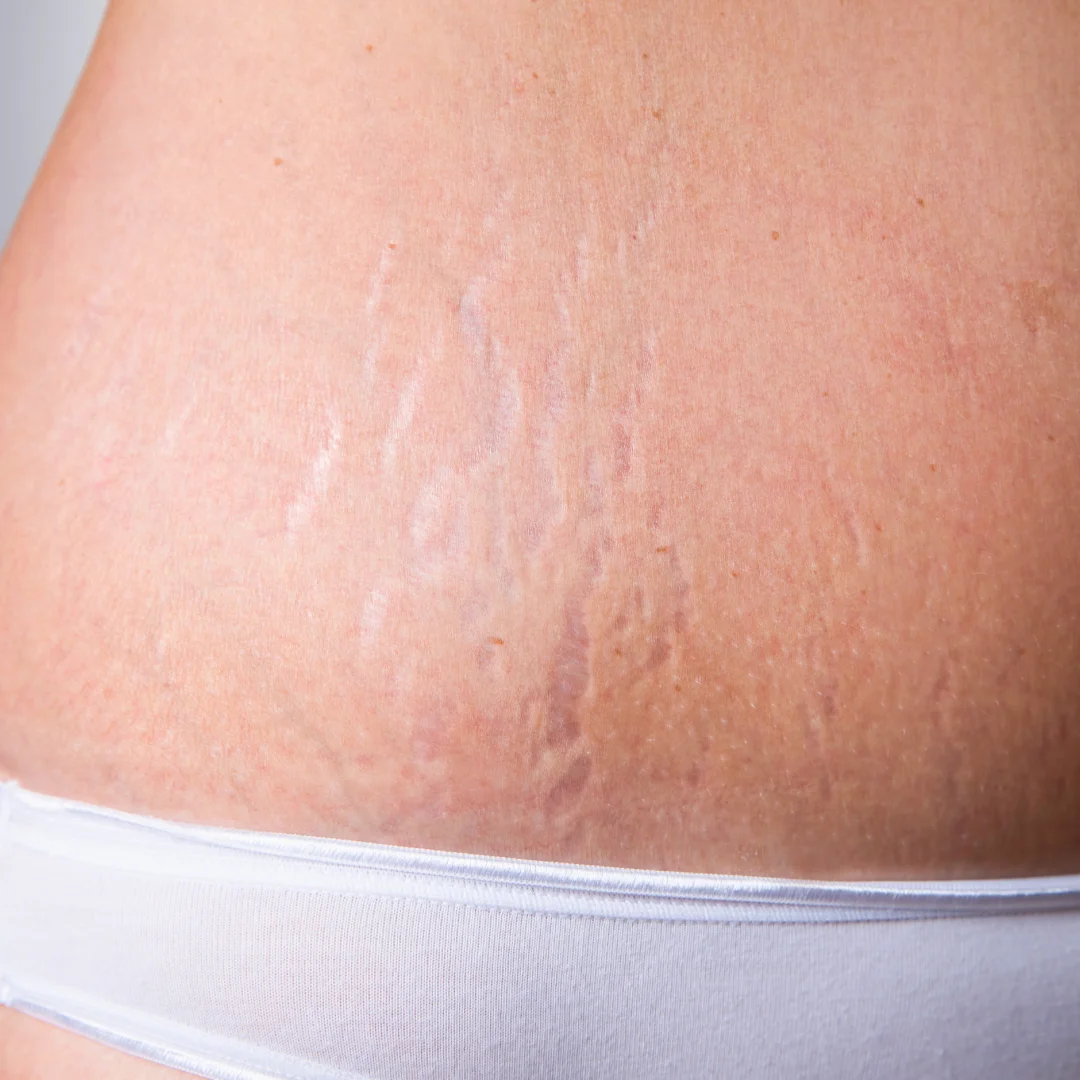 stretch mark and scarring