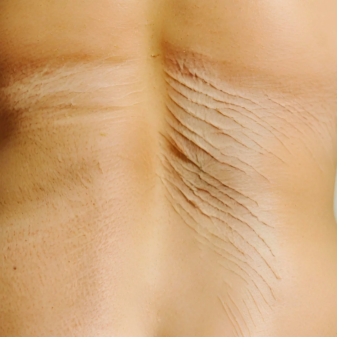 stretch marks andscarring on the back